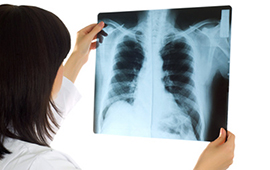 Ärztin-Röntgenbild-Schatten-auf-Lunge-COPD